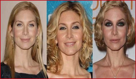 Elizabeth Mitchell Plastic Surgery Before and After